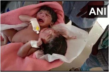 Rare Conjoined Twins Born In Odisha मह ल न द स र और त न ह थ व ल ज ड व बच च य क द य जन म ड क टर भ ह र न Viral News Rare Conjoined Twins Born In Odisha With