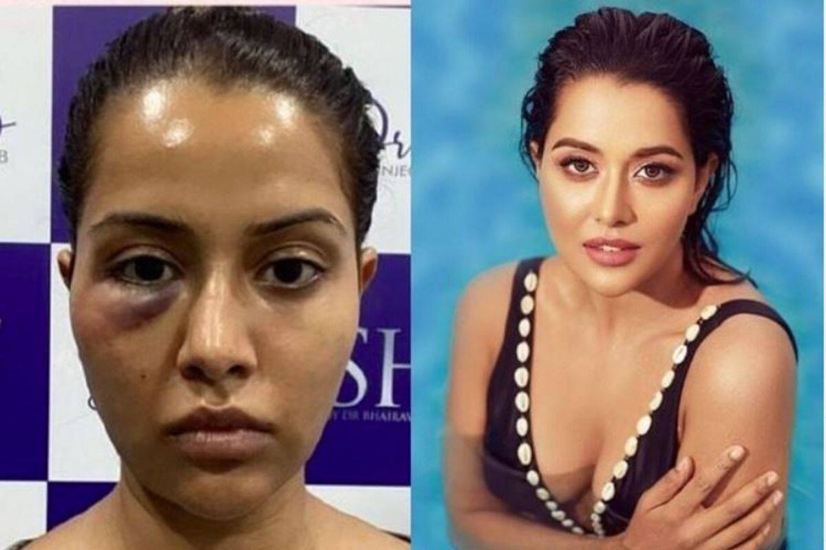 Tamil Actor Raiza Wilson's Face Treatment Goes Wrong, Bashes Dermatologist  Who Forced Her to Undergo Treatment