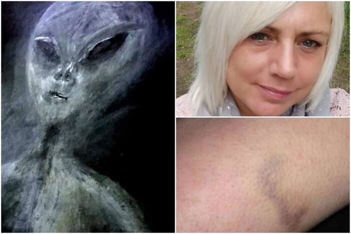 Woman Claims She Has Been Kidnapped by Aliens 52 Times in a UFO, Says Marks on Her Body Prove It!