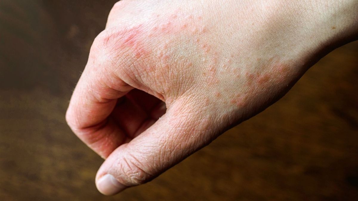 Covid Precaution is Causing Dermatitis to 2/3rd Population, Find ...