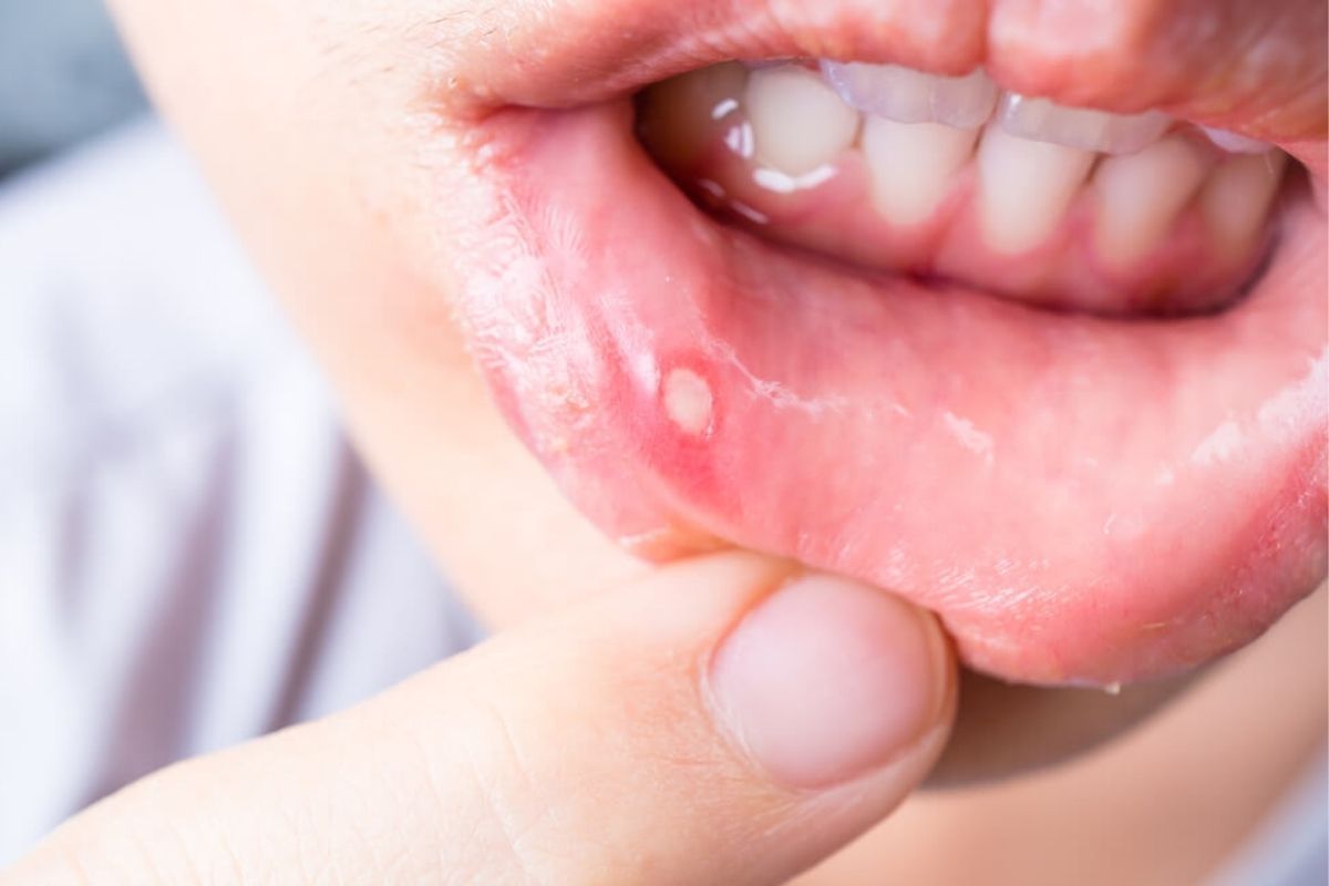 Mouth Ulcer In Marathi 