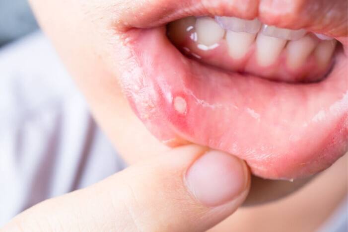 Mouth Ulcer Meaning In Marathi