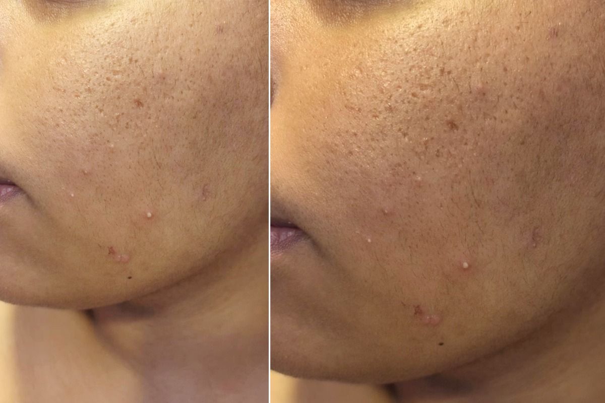 Laser Skin Treatment For Open Pores