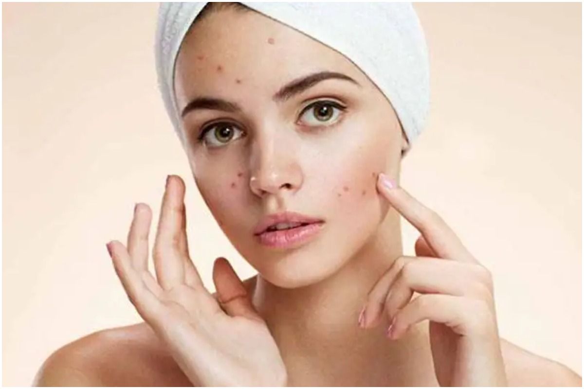 Home Remedies For Acne: 5 Simple Ways to Tackle Unbearable Hormonal Acne at Home