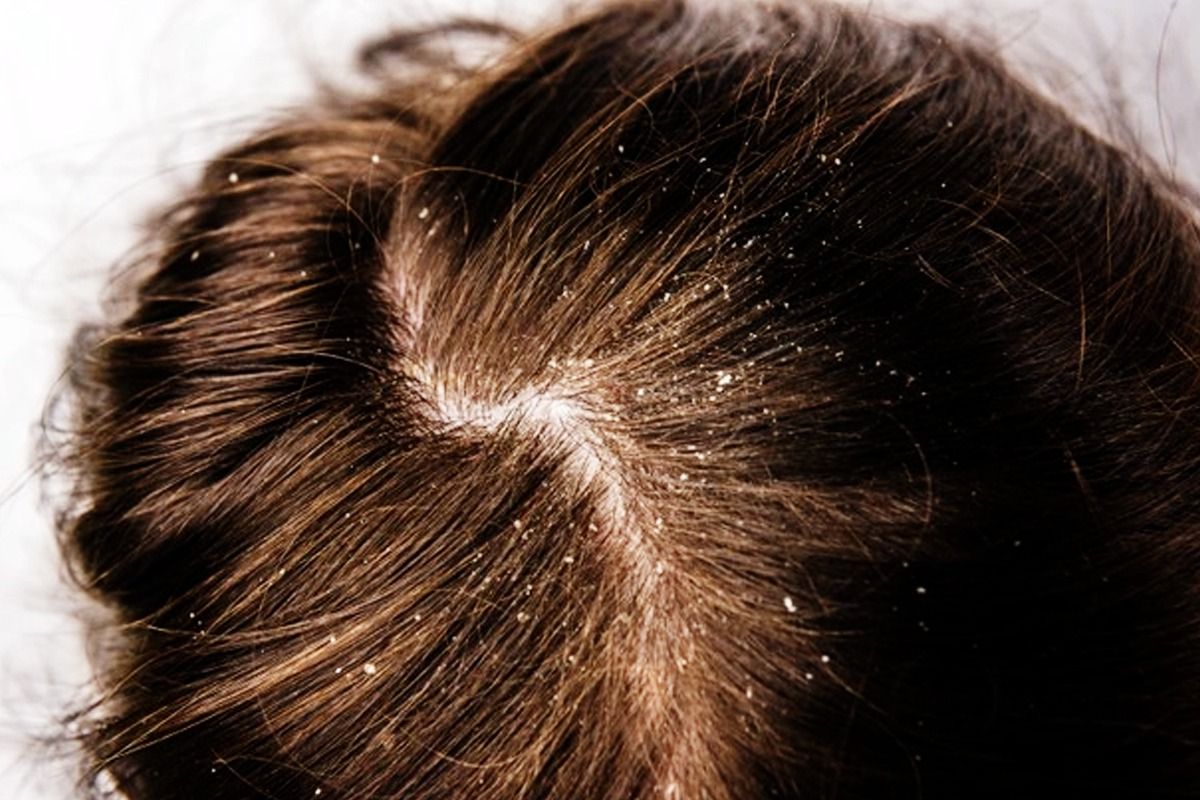 Home Remedies For Dandruff And Itchy Scalp  Feminain