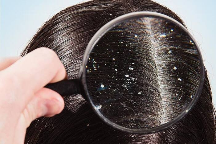 Dandruff in Winter