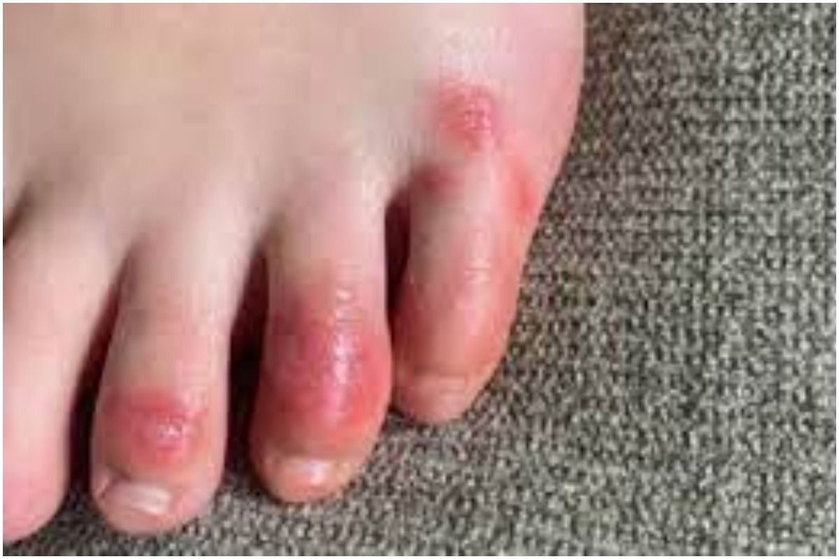 Swelling In Winters: सर्दियों का मौसम आते ही आपकी भी हाथ-पैरों की उंगलियों  में आने लगती है सूजन? अपनाएं ये आसान से घरेलू उपाय