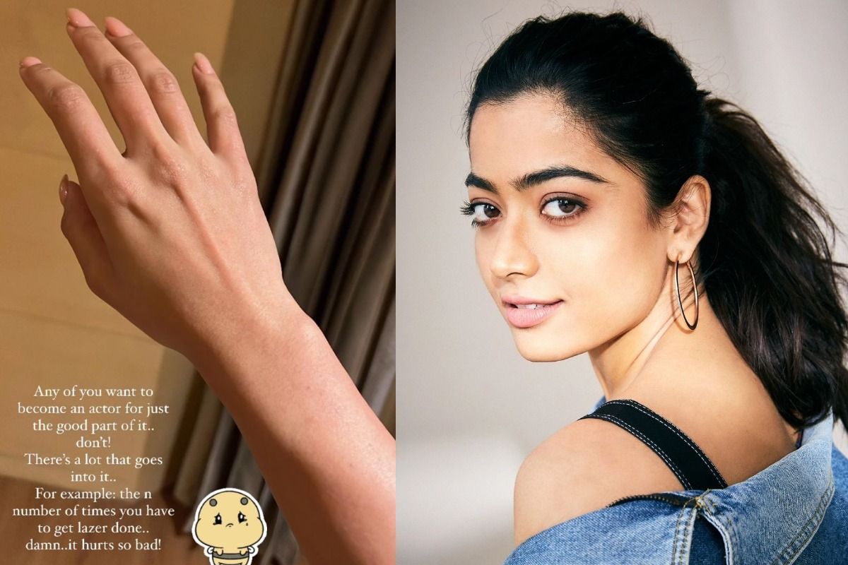 Rashmika Mandanna Gives a Glimpse of Her Laser Treatment on Arms Says Its  Not Easy To Be An Actor