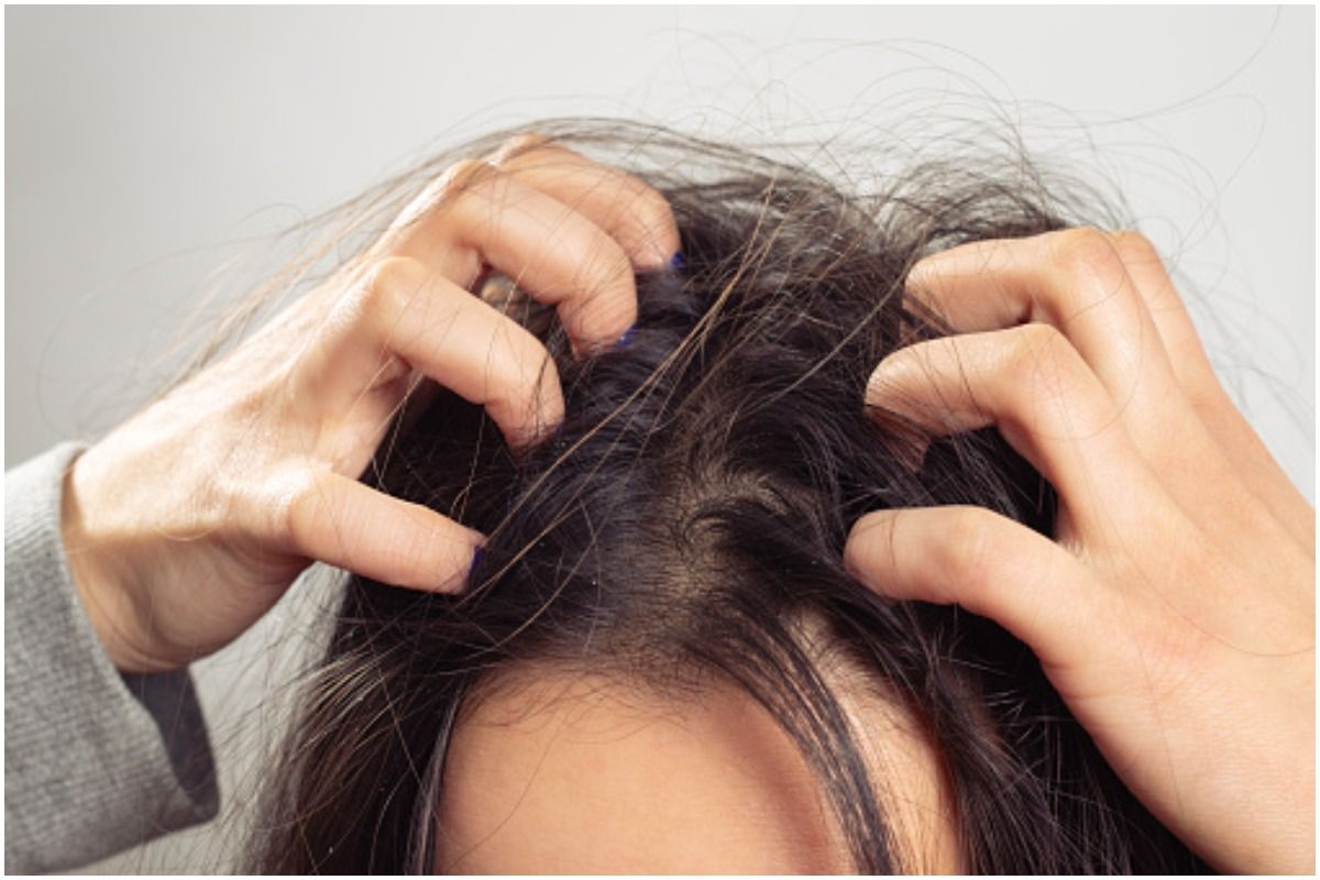 7 Ayurveda Solutions to Get Rid of Dandruff Instantly