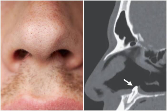 Man Who Had Trouble Breathing Discovers That a Tooth Was Growing Inside His Nose!