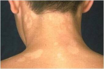 All About Tinea Versicolor - Causes, Treatment and Prevention All About Tinea Versicolor - Causes, Treatment and Prevention