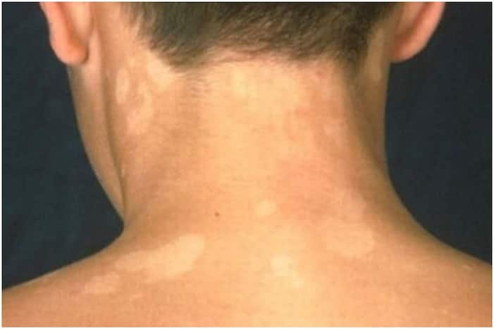 All About Tinea Versicolor Causes Treatment And Prevention