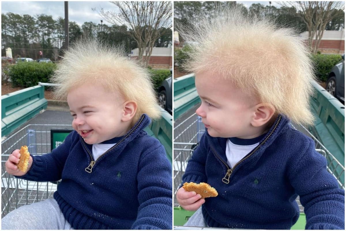 What is Uncombable Hair Syndrome, Rare Genetic Condition That This Toddler  Was Born With?