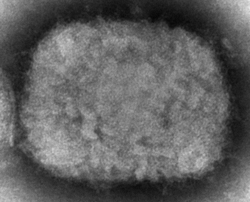 US Reports First Case of Monkeypox in Massachusetts Man