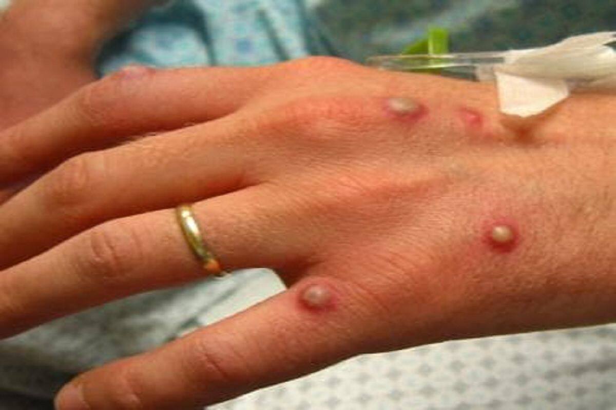 Monkeypox Virus Cases Confirmed in 12 Countries So Far. Full List Here