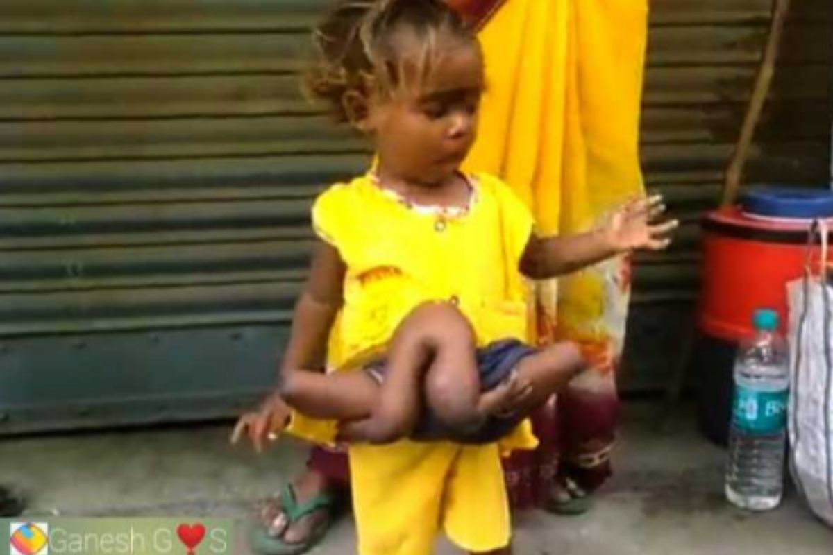 Viral News: आश्चर्यच! या मुलीला आहे चार हात आणि चार पाय! पाहून डॉक्टरही झाले चकित
