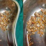 206 Kidney Stones Removed From 56-Year-Old Hyderabad Man In 1-Hour Surgery