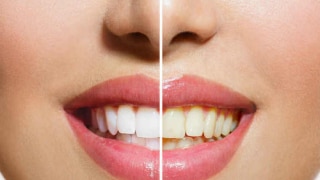5 Home Remedies to Whiten Your Teeth Naturally, Recommended by Shahnaz Husain