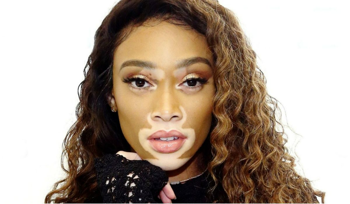 World Vitiligo Day 2022: 5 Common Myths About Leucoderma That You Should Be Aware Of