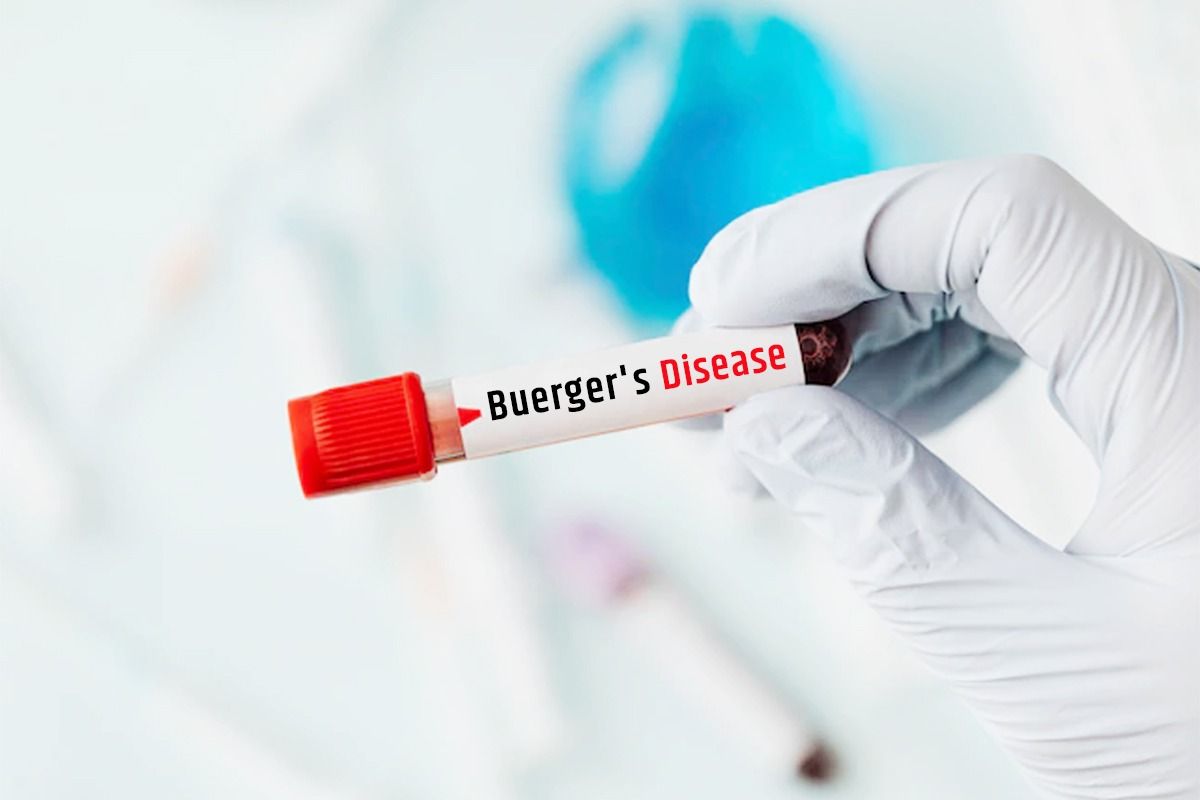 What is Buerger's Disease? Know Symptoms, Causes And Treatment of This Rare Disease