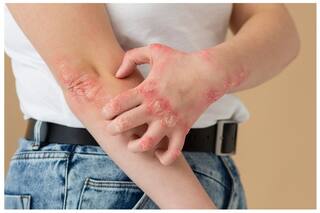 Diabetes And Skin Problems: 5 Expert-Backed Tips on How to Prevent Skin Issues in Diabetes