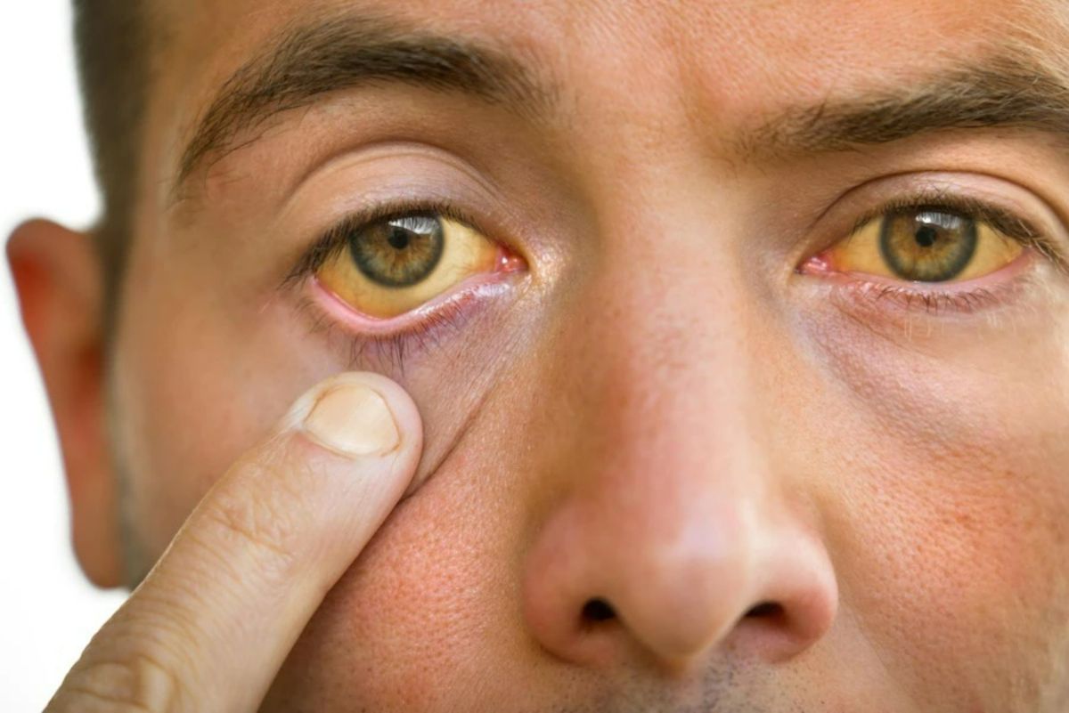 High Cholesterol: Your Eyes Can Detect These 3 Warning Signs of Bad  Cholesterol