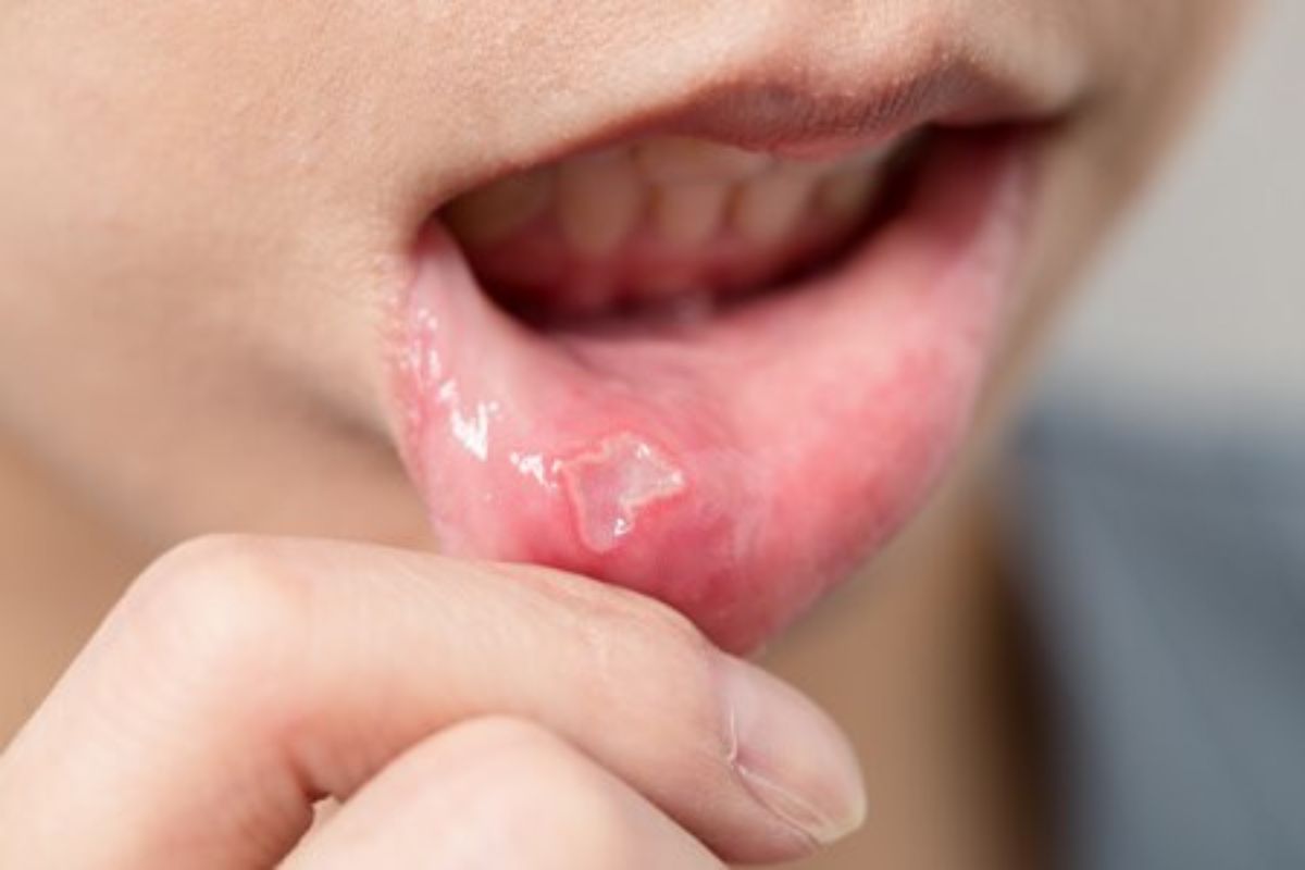 mouth-ulcer-remedy