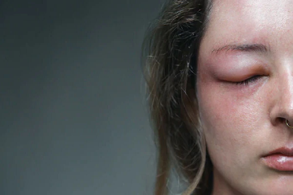 Swelling on Face Thyroid In Hindi Swelling on Face Thyroid In Hindi
