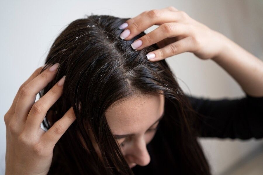 Tired of White Flakes Aka Dandruff in Your Hair| 5 Home Remedies To Combat  It Naturally