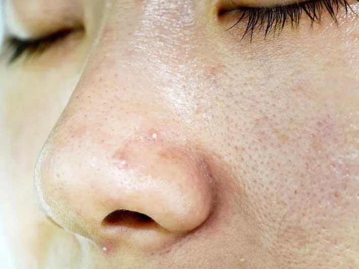 अगर आपका कॉलेस्ट्रॉल बढ़ गया है तो स्किन पर नजर आएंगे ये 10 लक्षण