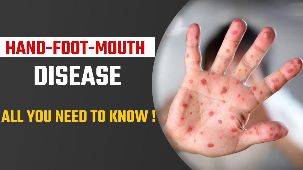 Hand, Foot And Mouth Disease: What Is It? Causes, Symptoms And ...