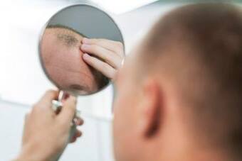 Male Pattern Baldness: What Causes Hair Loss in Men And How it Can be  Treated?