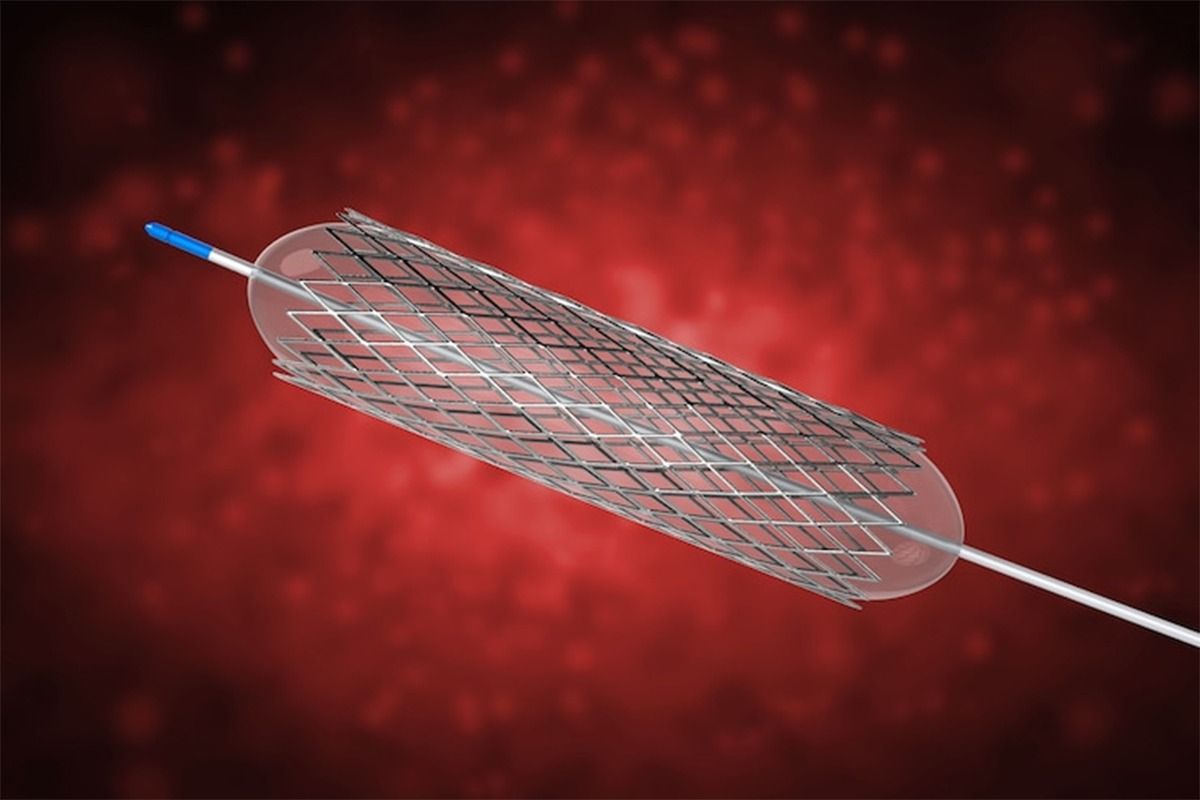 स्टेंट डलवाने के बाद भी क्यों ब्लॉक हो जाती हैं नसें?, जाने स्टेंट डलवाने के बाद भी क्यों ब्लॉक हो जाती हैं नसें?, जाने