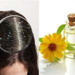 Dandruff Remedies: Does Oiling Hair Increase Dandruff? Expert Speaks!