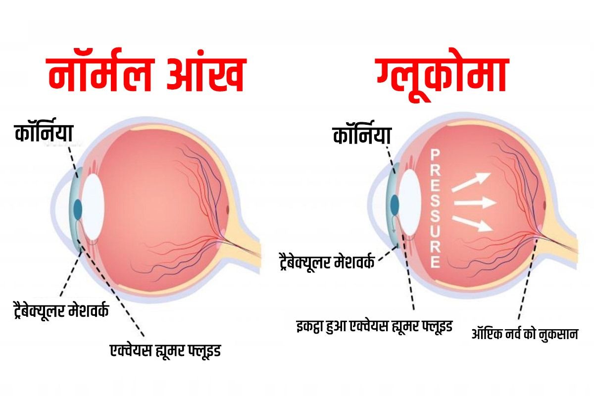क्या है, जानें काला मोतियाबिंद के लक्षण, कारण और इलाज