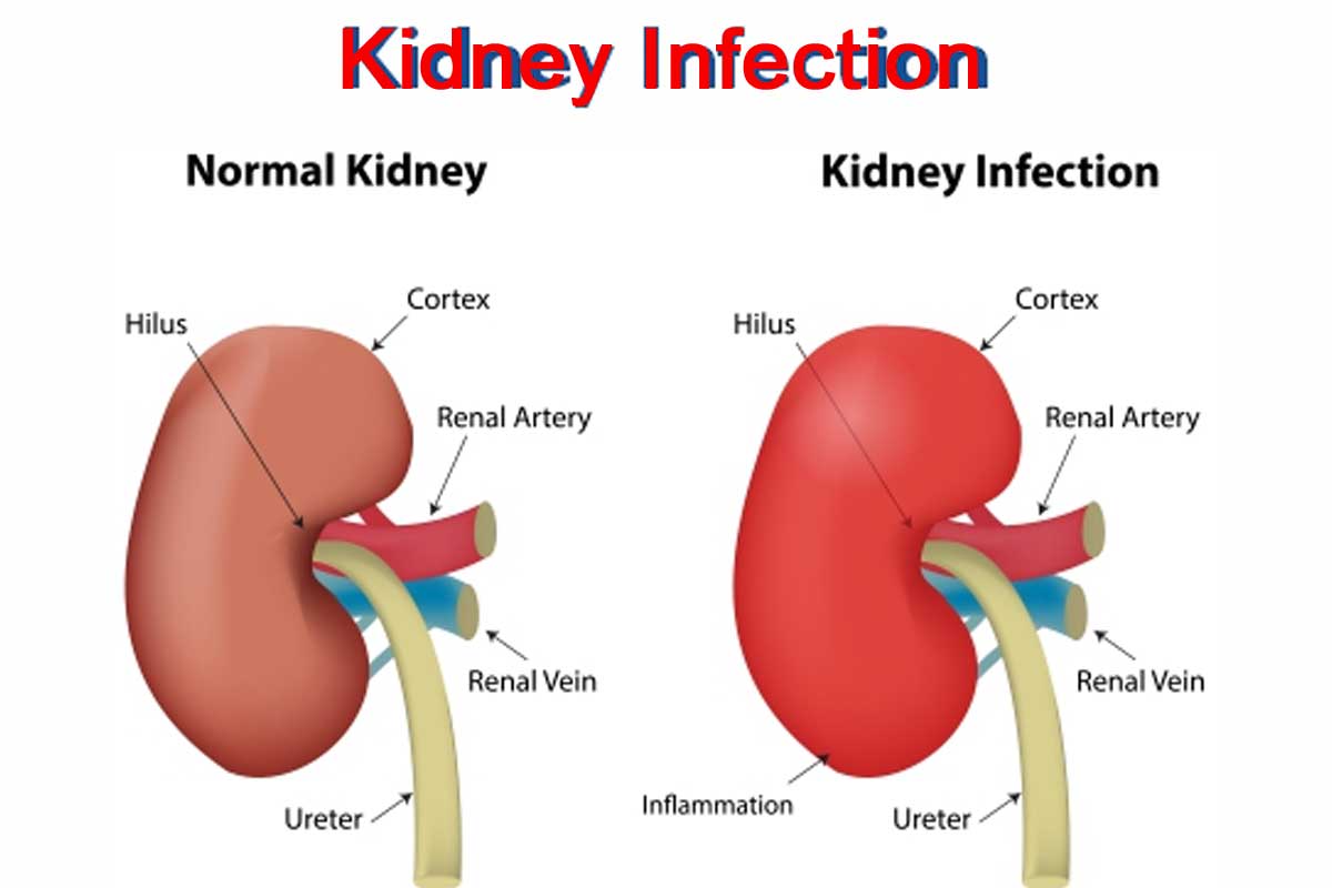 How Do Doctors Detect A Kidney Infection