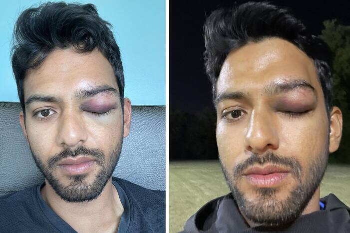 अमेरिका में क्रिकेट खेल रहे उन्मुक्त चंद की आंख में लगी चोट, बड़ी दुर्घटना से बाल-बाल बचे