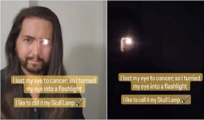 Viral Video: This Man Lost His Eye To Cancer So He Turned It Into a ...