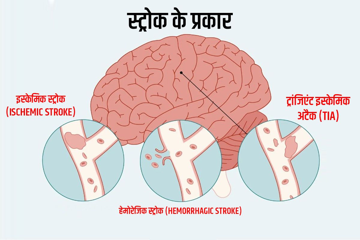 Stroke स्ट्रोक क्या है, कितनी तरह का होता है, जानें इसके लक्षण, कारण