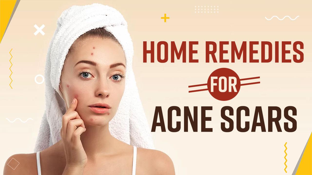 Skincare Tips: Struggling With Acne Scars? Try These Effective Home ...