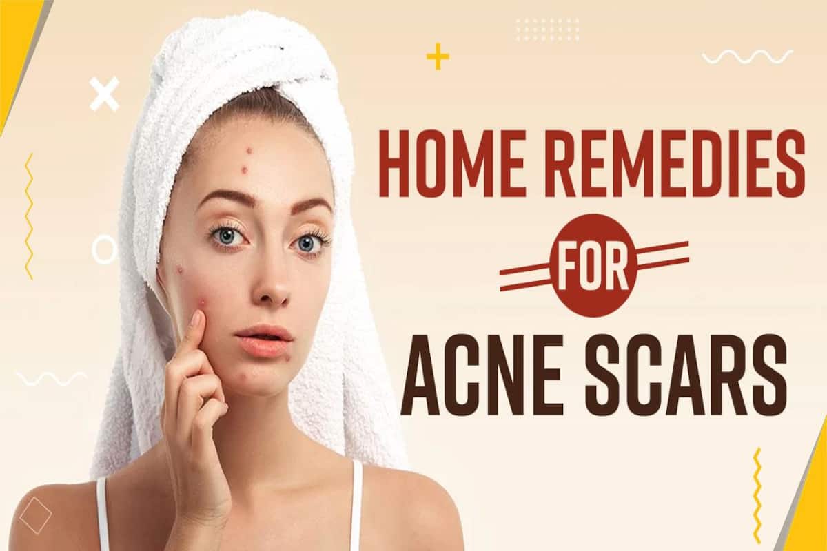 indian home remedy for acne