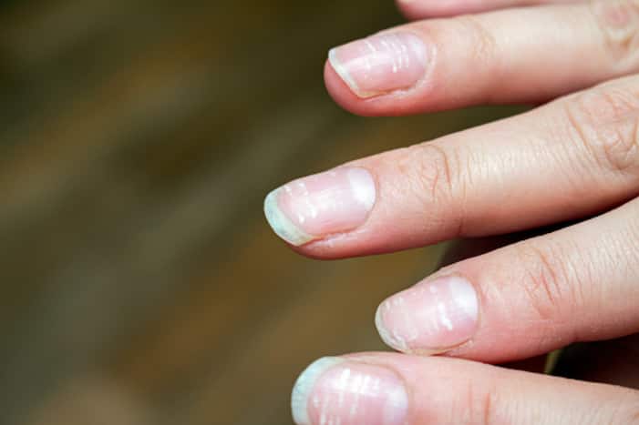 Iron Deficiency: 5 Early Indications to Identify Iron Insufficiency on Skin, Hair And Nails