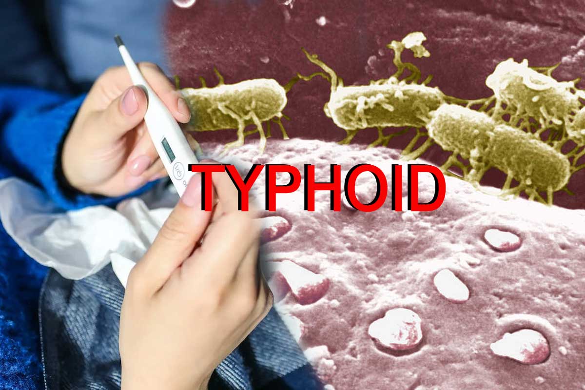 typhoid-10