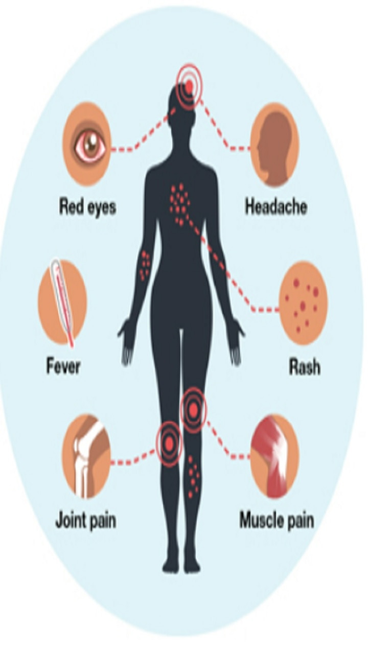 Zika Virus — Symptoms And Causes