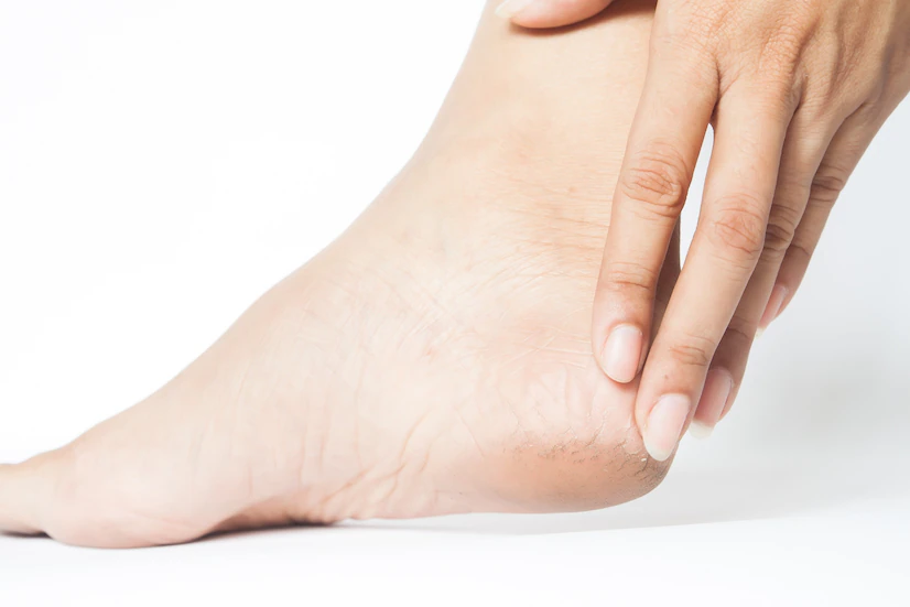 Cracked Heels? Here’s How You Can Repair Them by Using Shahnaz Husain Tips