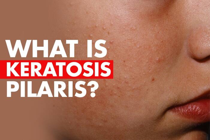 Chicken Skin is Actually a Serious Condition, Check Treatment of Keratosis Pilaris