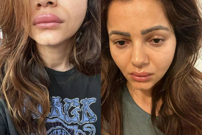 Rubina Dilaik Shares Pics of Her Swollen Face And Duck Lips, Fans Say 'We are Worried For You'- Check Post