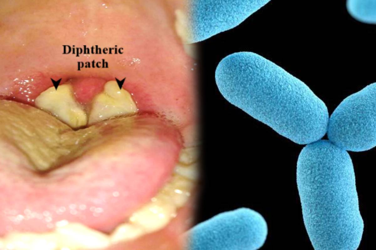 Diphtheria Outbreak in Nigeria: अफ्रीकी देश नाइजीरिया में डिप्थीरिया का ...