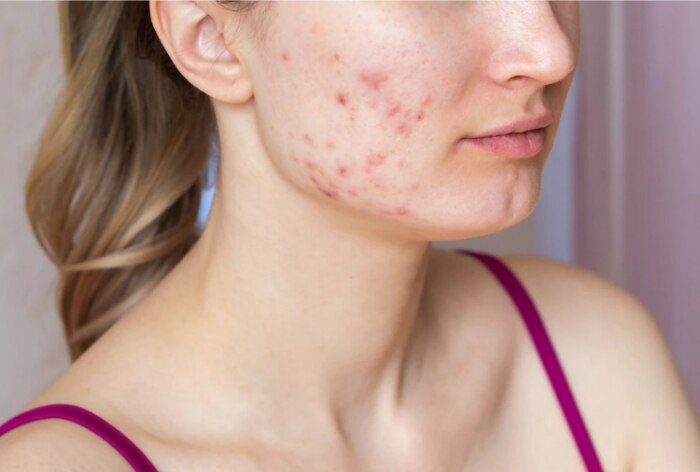 Anti-Acne Diet: Include 4 Vitamins in Your Meals to Help Get Rid of Acne