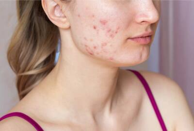 Anti-Acne Diet: Include 4 Vitamins in Your Meals to Help Get Rid